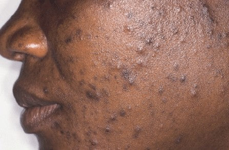 How to prevent and get rid of dark spots (hyperpigmentation) and acne –  AUMELLO